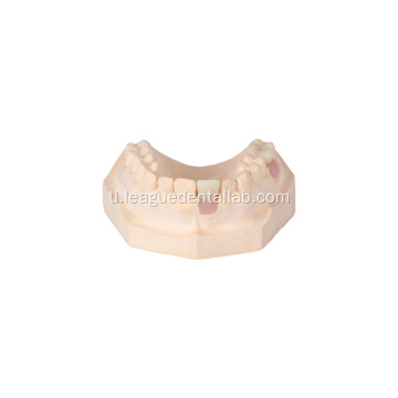 Na -customize na layered na korona ng zirconia